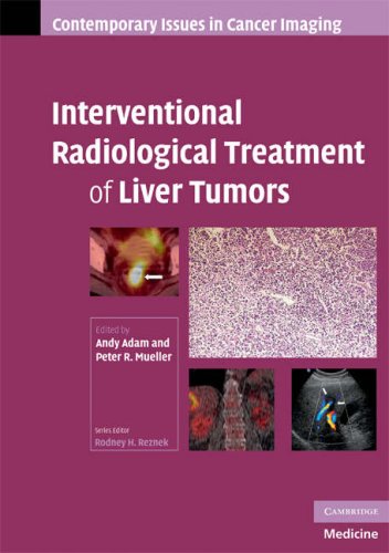 

surgical-sciences/oncology/interventional-radiological-treatment-of-liver-tumors-9780521886871