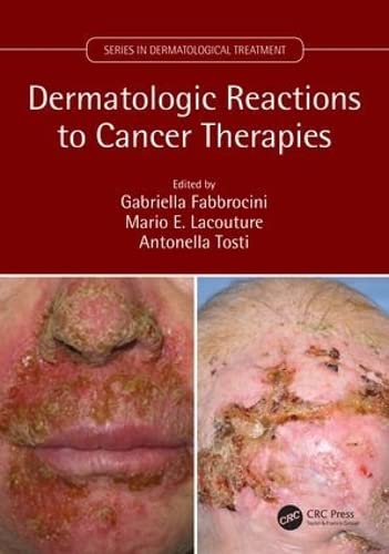 DERMATOLOGC REACTION TO CANCER THERAPIES- ISBN: 9781138035539