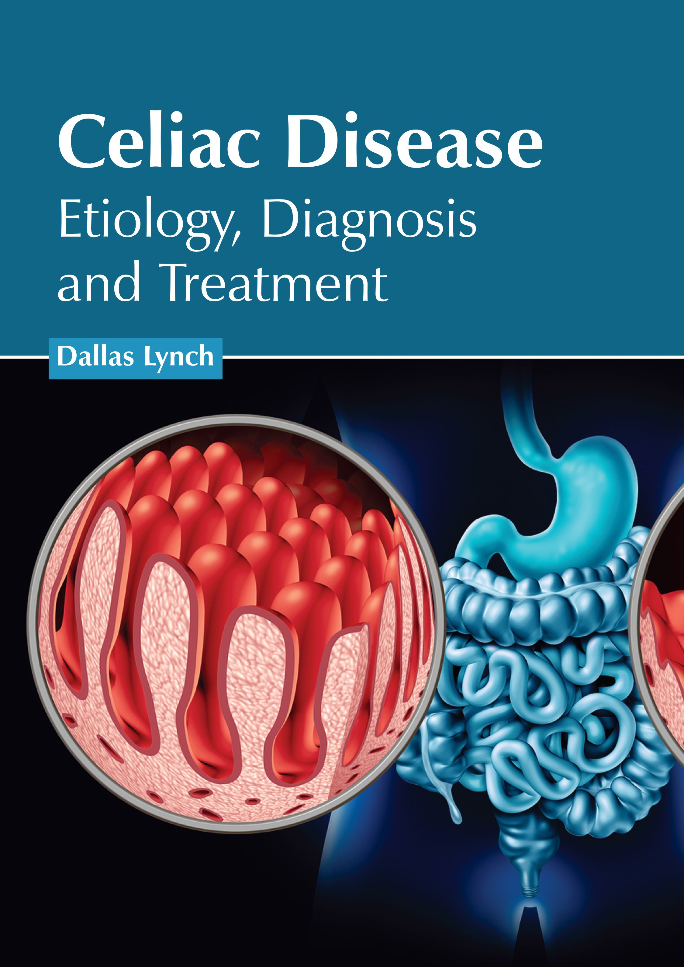 CELIAC DISEASE: ETIOLOGY, DIAGNOSIS AND TREATMENT
