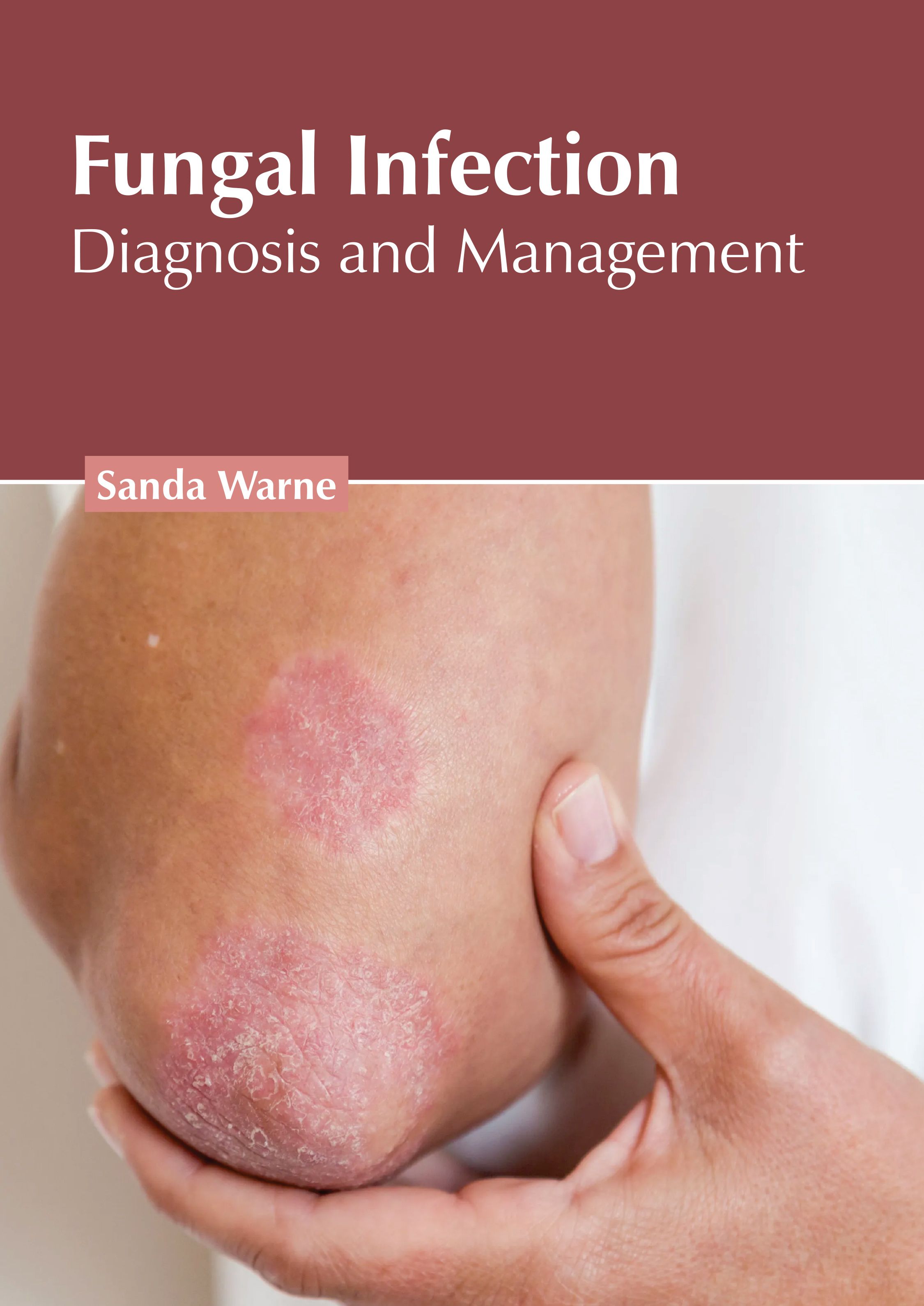 FUNGAL INFECTION: DIAGNOSIS AND MANAGEMENT