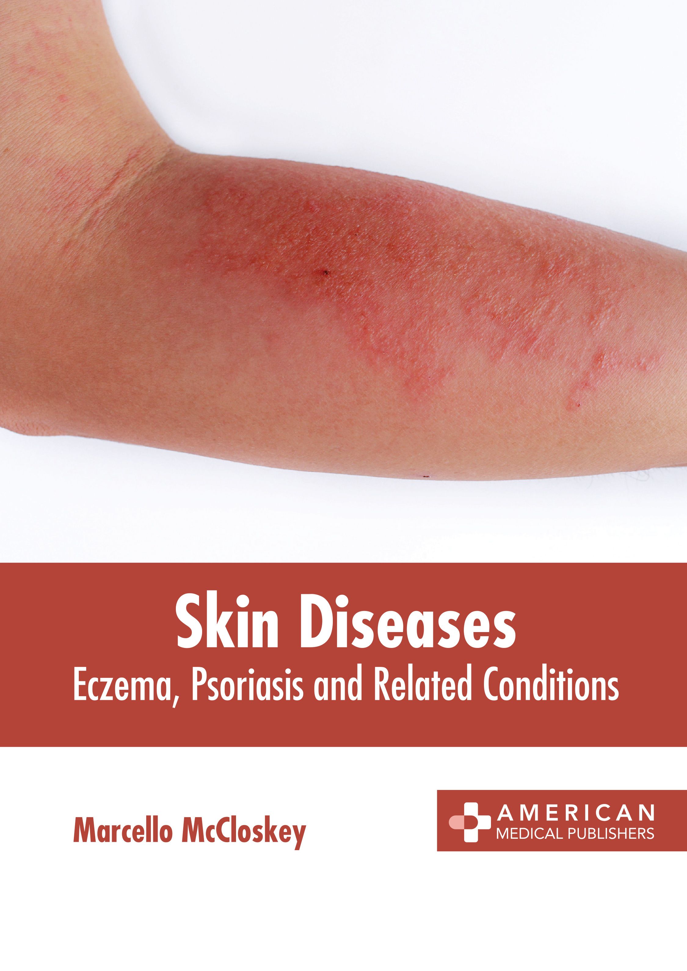 SKIN DISEASES: ECZEMA, PSORIASIS AND RELATED CONDITIONS