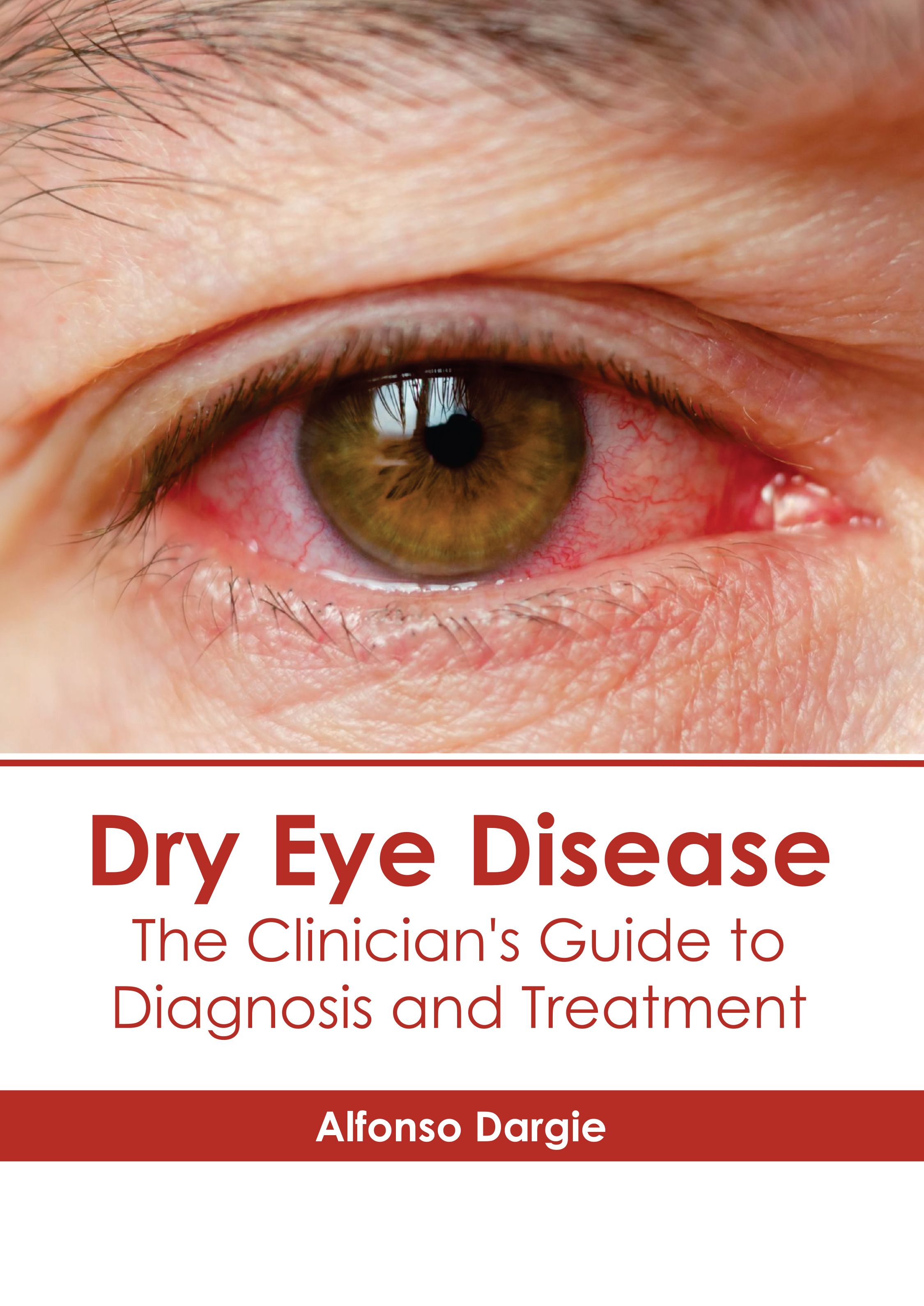 DRY EYE DISEASE: THE CLINICIAN'S GUIDE TO DIAGNOSIS AND TREATMENT