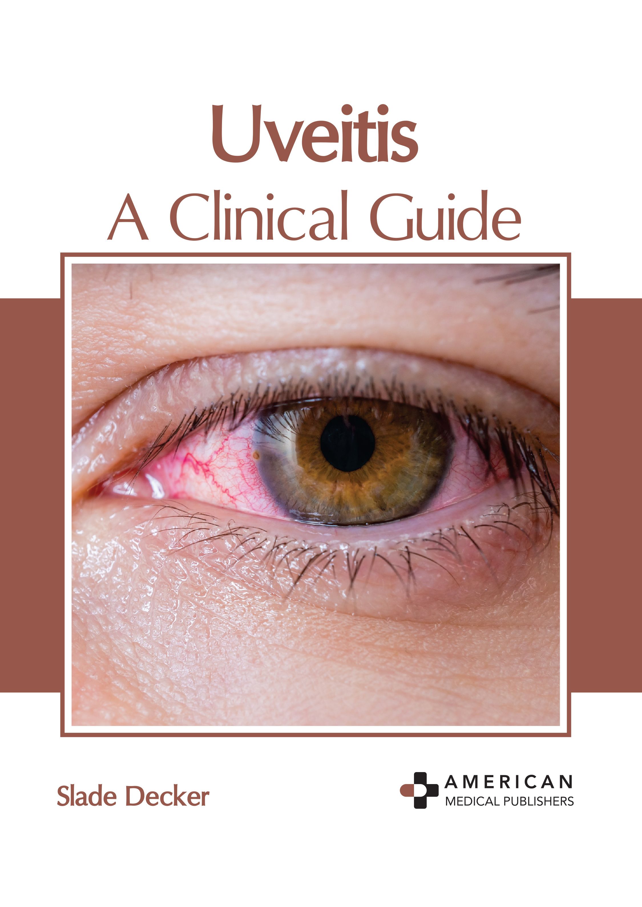 UVEITIS: A CLINICAL GUIDE