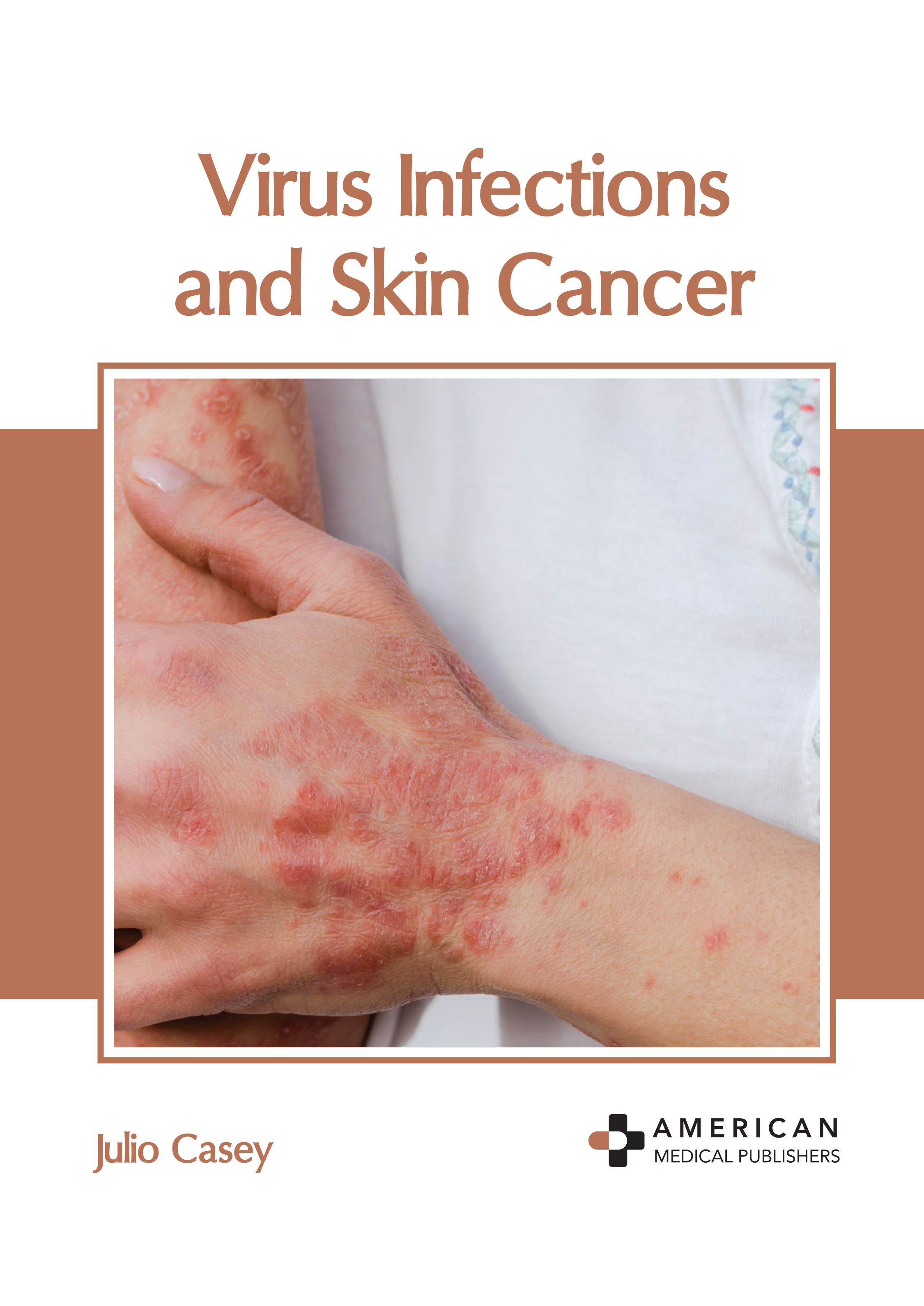 VIRUS INFECTIONS AND SKIN CANCER